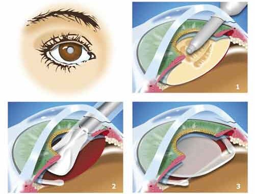 Symptômes de la cataracte